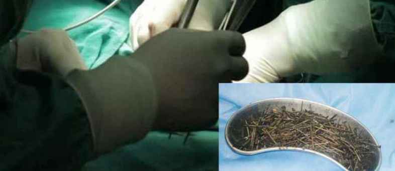 Doctors remove 115 nail from man’s stomach.jpg Doctors remove 115 nail from man’s stomach.jpg