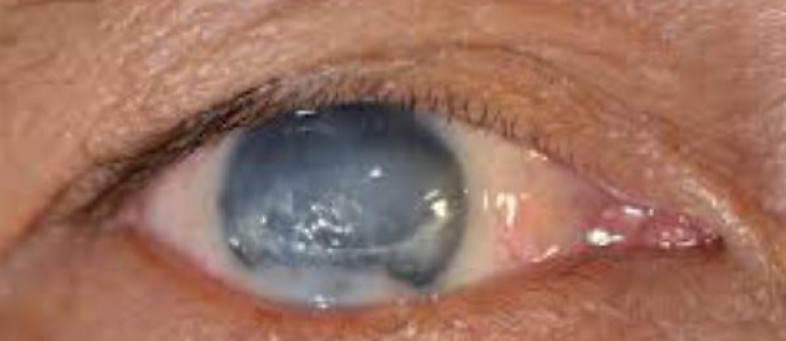 glaucoma.jpg glaucoma.jpg