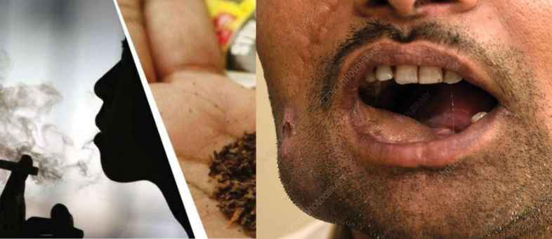 Ahmedabad has the highest number of oral cancer cases in the country due to smoking.jpg Ahmedabad has the highest number of oral cancer cases in the country due to smoking.jpg